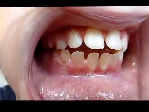 download lagu mp3 mp4 Tongue Thrust Teeth, download lagu Tongue Thrust Teeth gratis, unduh video klip Tongue Thrust Teeth