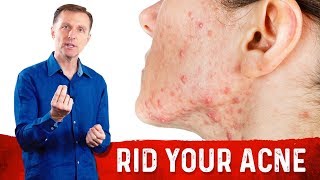 How To Get Rid Of Acne Fast? Try Dr.Berg