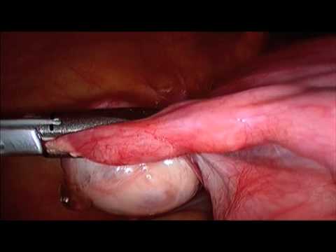 Laparoscopic Supracervical Hysterectomy 18 Weeks Uterus