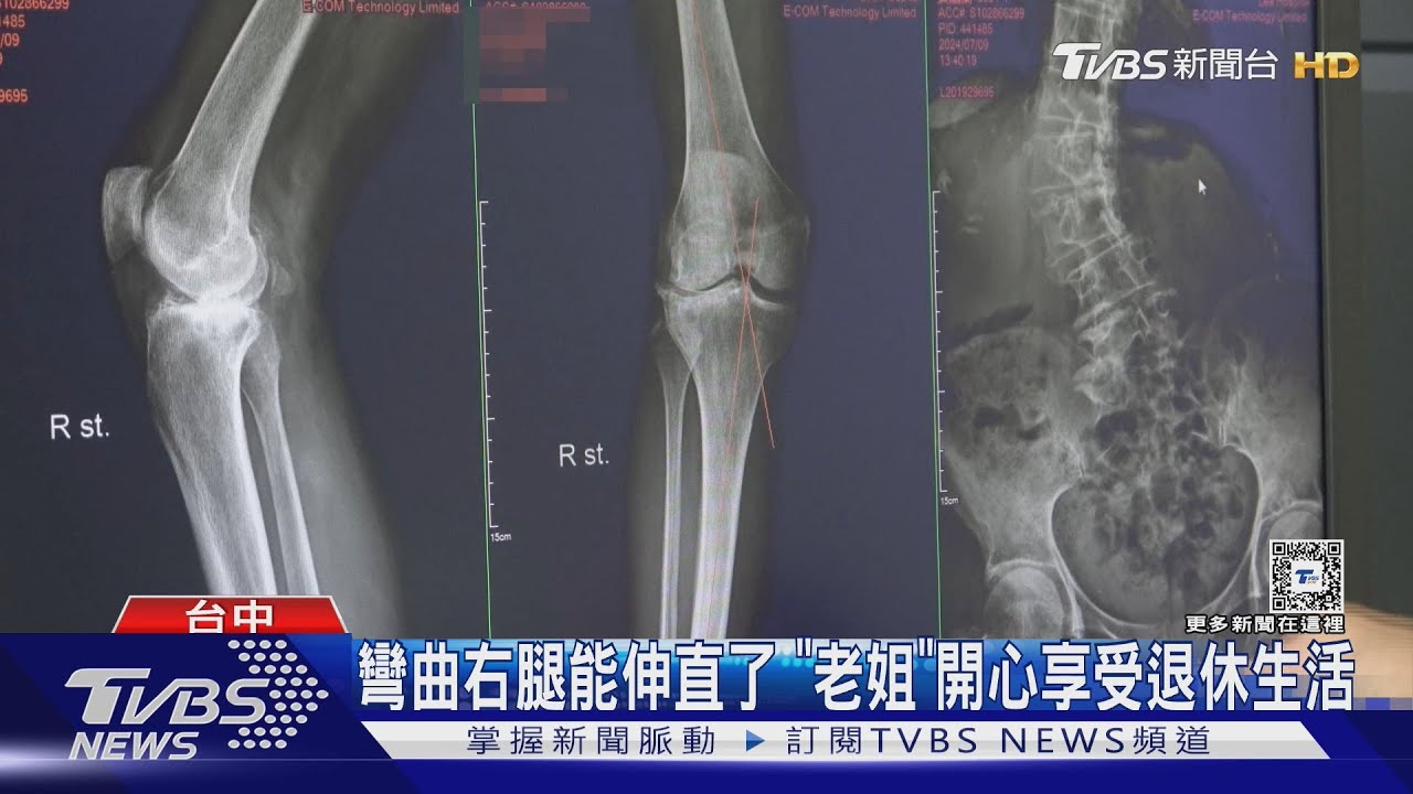 彎曲右腿能伸直了 「老姐」開心享受退休生活