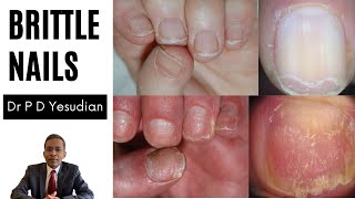 Brittle nails - causes and treatment