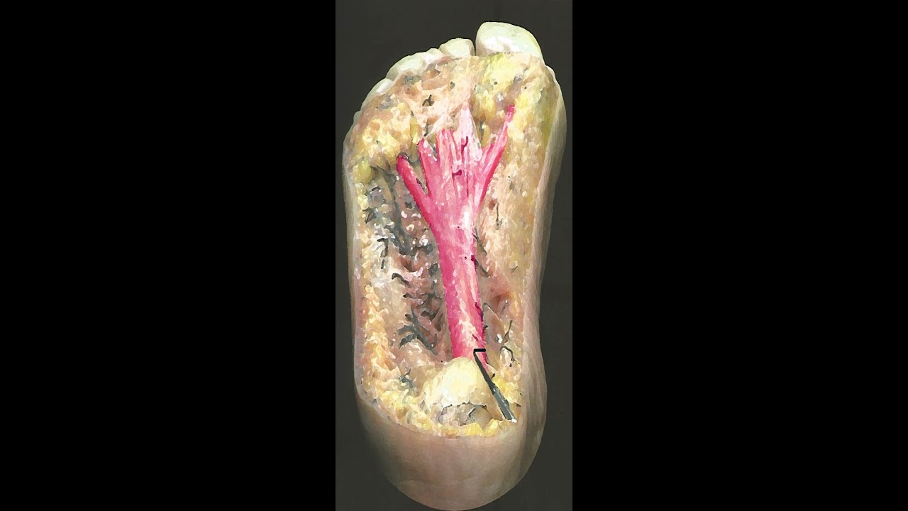Watch Now FASCITE PLANTARE E SPINA CALCANEARE: TECNICA PERCUTANEA FASCITE PLANTARE E SPINA CALCANEARE: TECNICA PERCUTANEA