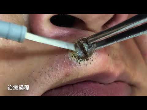 凸痣長毛
