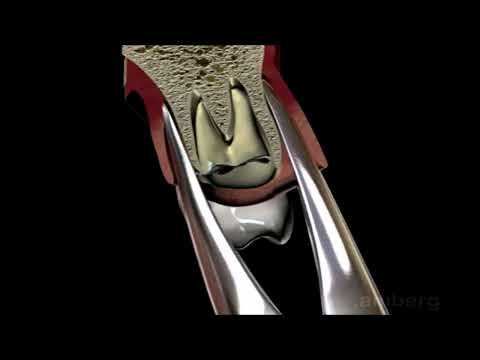 Extraction Upper Root Tips   GMX 69 Forceps