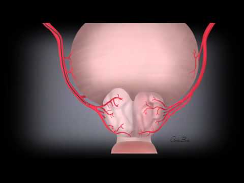 New BPH Treatment for enlarged prostate: Prostatic Artery Embolization (PAE) at UNC Health Care