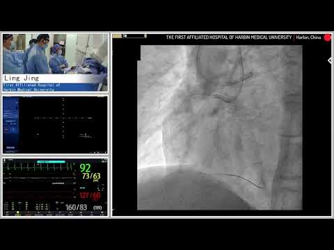 PCI to RCA CTO With Antegrade Approach And Retrograde Approach For Backup Plan