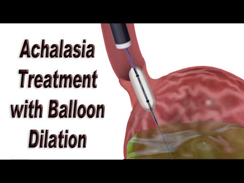 Achalasia Treatment with Endoscopic Balloon Dilation