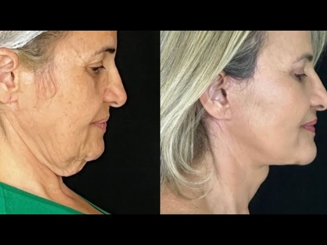 Tratamentos envolvidos no Facelifting Moderno