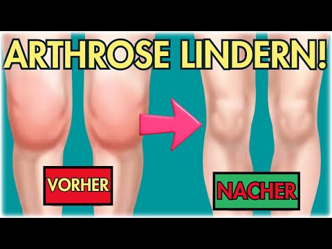 Stop fluid loss: This exercise will save your knee if you have osteoarthritis!