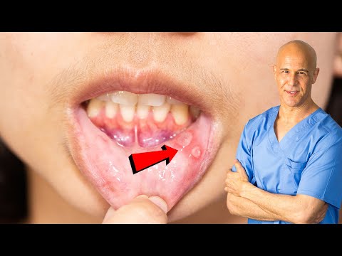 How I Quickly Healed My Canker Sore | Dr. Mandell