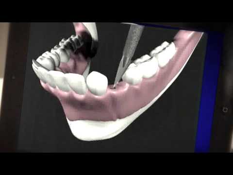 2. Behandlungsschritt: Implantat setzen