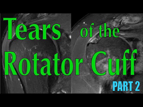 Tears of the Rotator Cuff Part 2: Identifying Tears on MRI