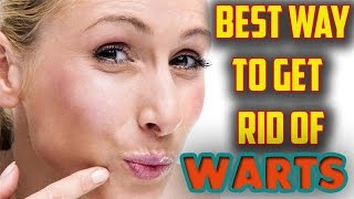 How To Get Rid Of Warts | 2 Ways To Remove Warts Naturally At Home
