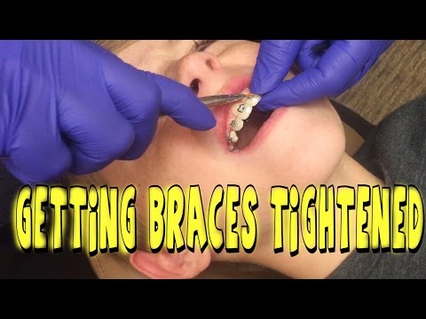 GETTING BRACES TIGHTENED FOR THE FIRST TIME Video
