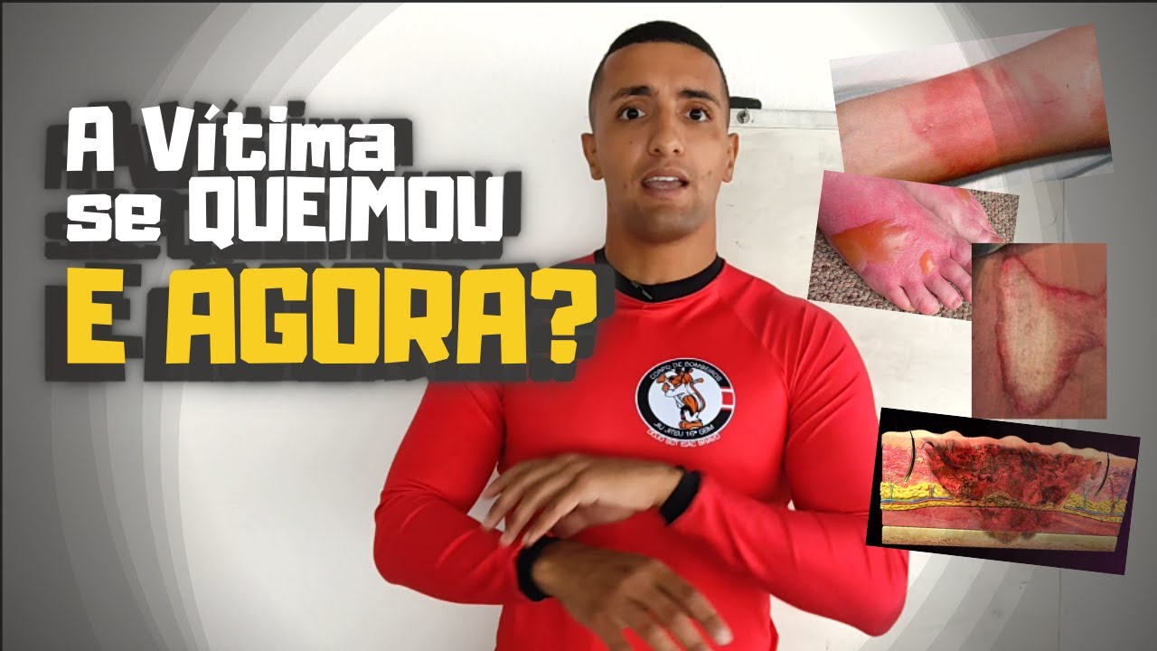 QUEIMADURAS: Graus, Tipos, Primeiros Socorros, Cálculo da Área Queimada e mais...