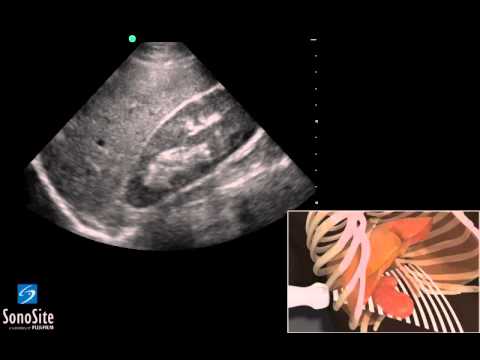 3D Lehrvideo: EFAST - Rechter oberer Quadrant