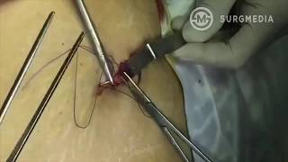 Quick and  Simple Technique of Umbilical Port Closure in Laparoscopic Surgery