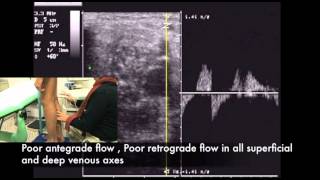 preview picture of video 'Absence of reflux for absence of the gradient in a case of valvular agenesia'