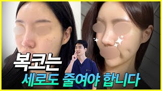 복코를 입체적으로 줄이자 #코수술 #코성형 #복코