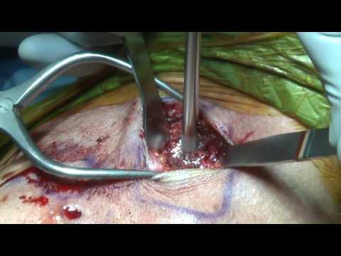 Reconstruction conjointe AC | Fixation coracoclaviculaire sans nœuds