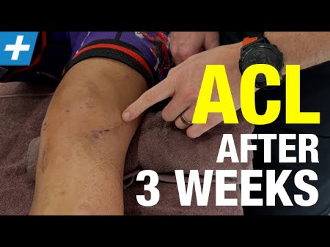 3 Weeks Post-op after ACL Reconstruction with a Lateral Tenodesis
