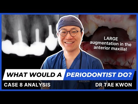 What Would A Periodontist o? with Dr Tae Kwon - Case 8