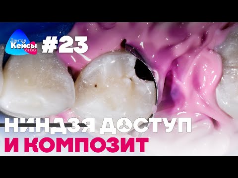 Ниндзя доступ и композит | Дентал Кейсы от BG #23