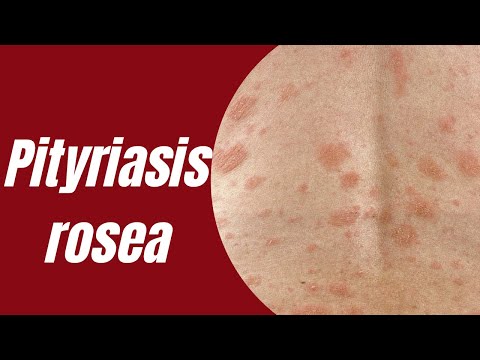 Pityriasis rosea | Causes | Symptoms | Treatments | Severe cases
