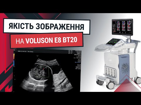 Деталізований скринінг GE Voluson E8 BT20 - Статті RH