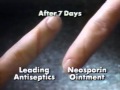Dramatic Cuts Neosporin Ointment Commercial 1991