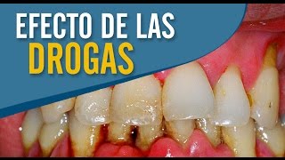 EFECTOS DE LAS DROGAS EN LA BOCA | Juan Fernando Salgado