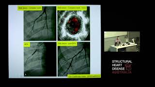 Balloon Pulmonary Angioplasty for CTEPH – Dr David Boshell