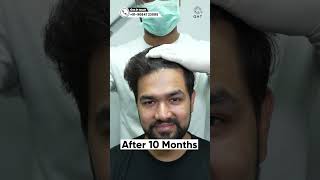 Ten Months Hair Transplant Result | Latest Fue Technique #shorts #vira