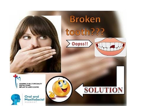Broken Tooth Restoration: Dr Arvind Agarwal M.D.S (oral and maxillofacial surgeon)