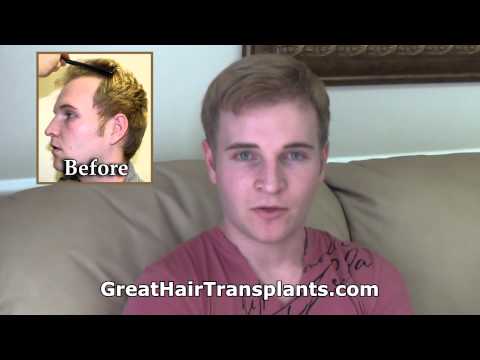 Prevent Hair Loss Before They Notice