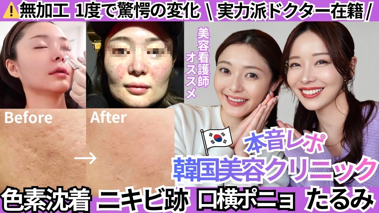 【🇰🇷韓国美容クリニックレポ】本気の治療はここ。最先端で金ドブ回避！日本語OK。美容看護師驚愕！圧倒的効果の小顔・リフトアップ・肌育・たるみ改善・アンチエイジングについて徹底解説