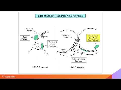 Complex Cases Simplified:  AVNRT Part II with Warren "Sonny" Jackman, MD