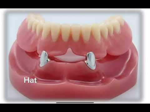What is a cover denture or overdenture? Basic knowledge explained simply.