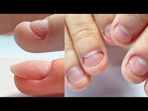 Cómo dejar de morderse las uñas? Manicura - de uñas mordidas a uñas hermosas