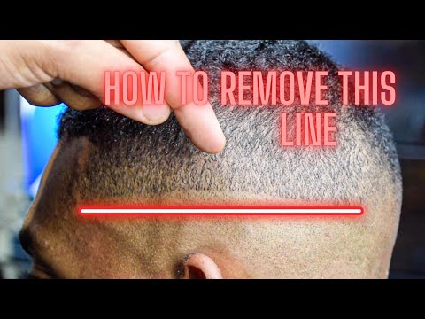 EASIEST WAY TO REMOVE A BALD GUIDELINE!