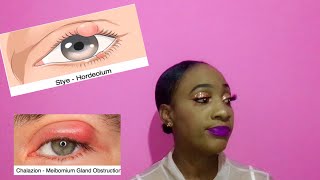 How to get rid of a Stye/Chalazion  at home | Bump /Lump on eye | Non Surgical way