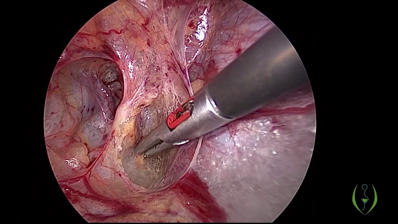 Laparoscopic myomectomy of large and oddly positioned myomas with uterine artery ligation at origin