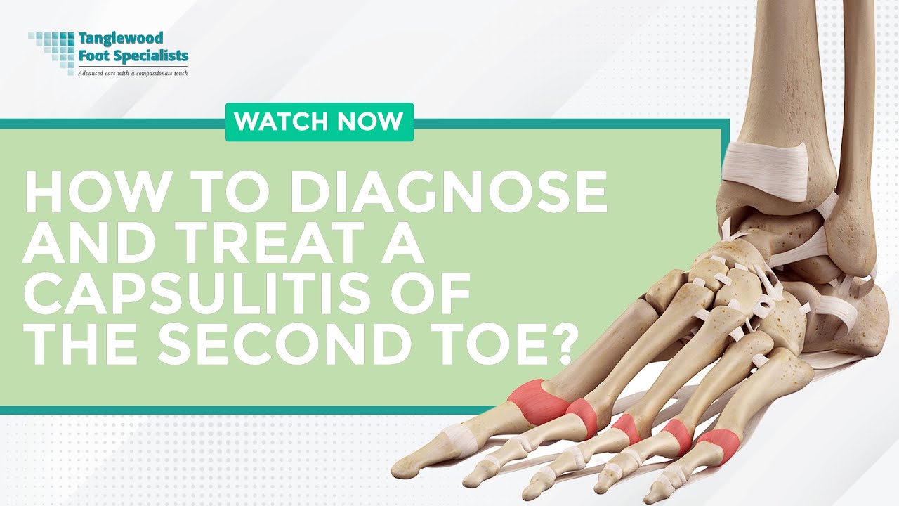 How to Diagnose and Treat a Capsulitis of the Second Toe