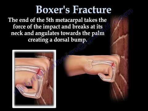 Forte spostamento delle ossa nel giunto è Per il trattamento di osteocondrosi 2