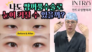 나도 쌍꺼풀수술로 눈이 커질 수 있을까?