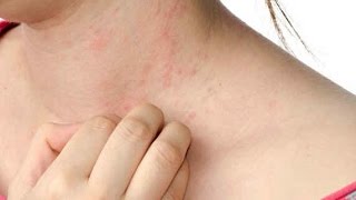 How to get rid of hives fast Home remedies | Cool &amp; Fast way