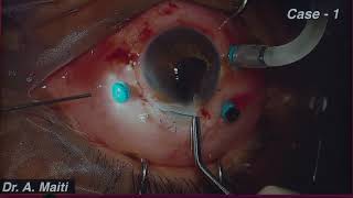 You tube video of Instruction Course conducted at All India Ophthalmological Society annual conference 2020