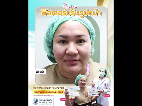 รีวิวหัตถการโปรแกรมปรับรูปหน้าแบบองค์รวมด้วยฟิลเลอร์