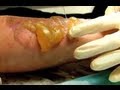 Hot Fat Burns - Bizarre ER