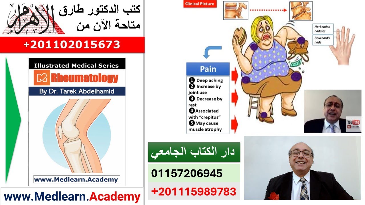 Osteoarthritis (OA) #cme #internal_medicine  #usmle #medicalschool   #medical #محاضرات_باطنة
